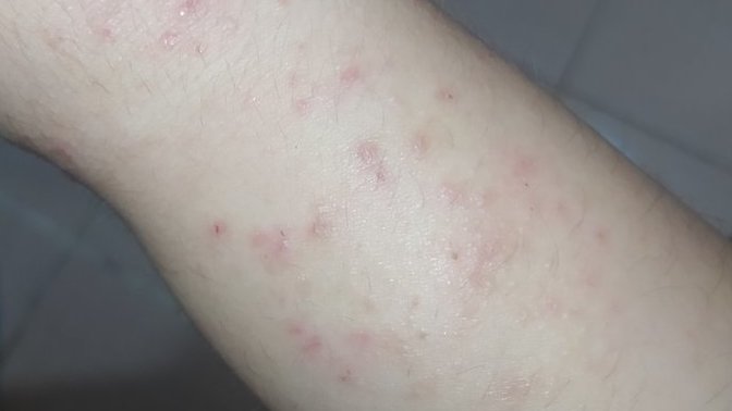 Elimdeki bu kabarcıklar uyuz mu yoksa stres kaynaklı kaşıntılar mı, acildeki bir doktor uyuz dedi başka bir doktor uyuz değil dedi?