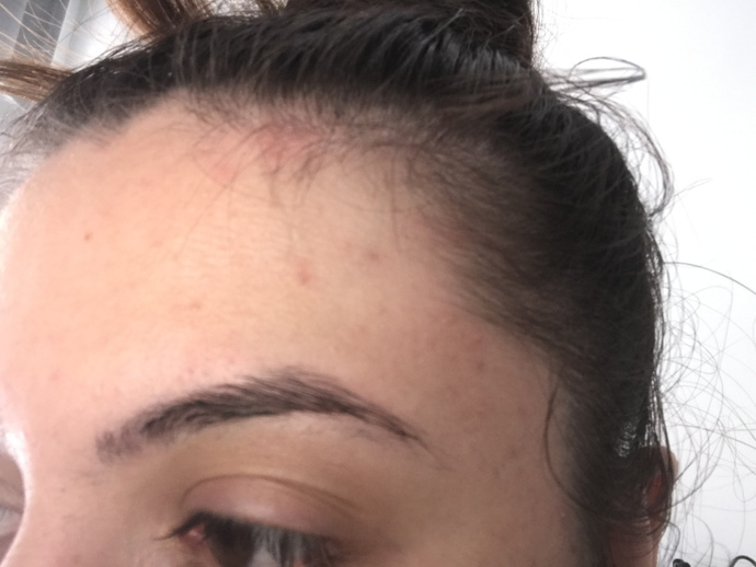 Kafamın içine doğru yayılan bu kızarıklıklar ne olabilir?