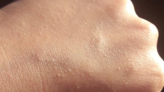 Yazın elde çıkan pütürcükler nedir?