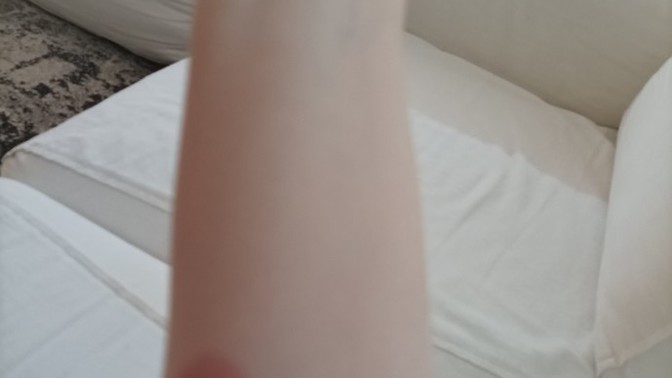 Yanık izi kalıcı mı? Ne kadar süreye geçer?