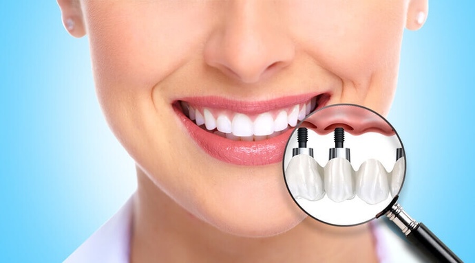 Merhaba implant yaptırmak acı veriyormu?