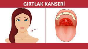Bir yakınım 2. evrede gırtlak kanseri daha önce yakını gırtlak kanseri olan var mı kurtulma şansı nedir nelere dikkat etmeli?