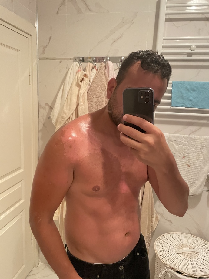 Güneş yanığına en hızlı ne iyi gelir?