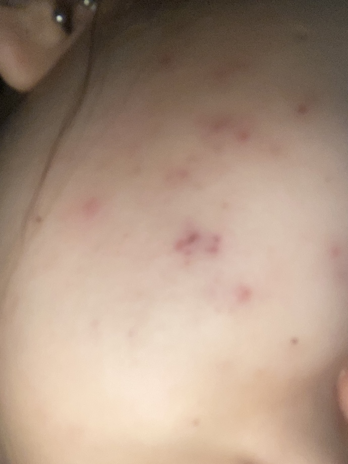 Sivilce izlerine bir çözümünüz var mı?