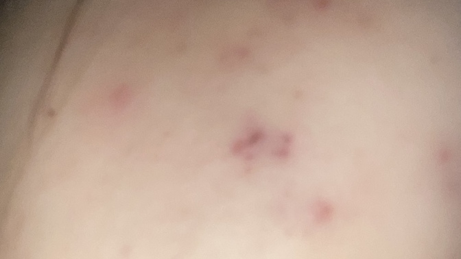 Sivilce izlerine bir çözümünüz var mı?