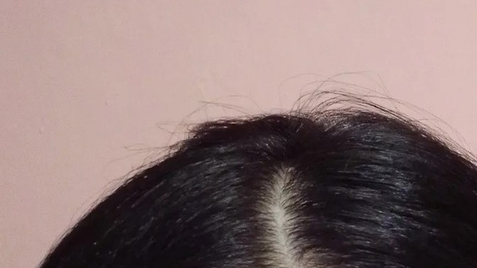 Daha 20 yaşındayım ama alnımda çizgiler var resimde çok belli olmuyor ama aynaya bakınca yüzüme on yaş daha katıyor nasıl geçer?