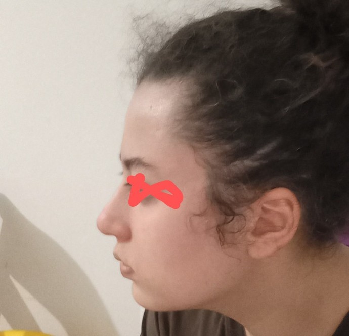 Yan profil sorunsalı! Burun estetiği gerekli mi?
