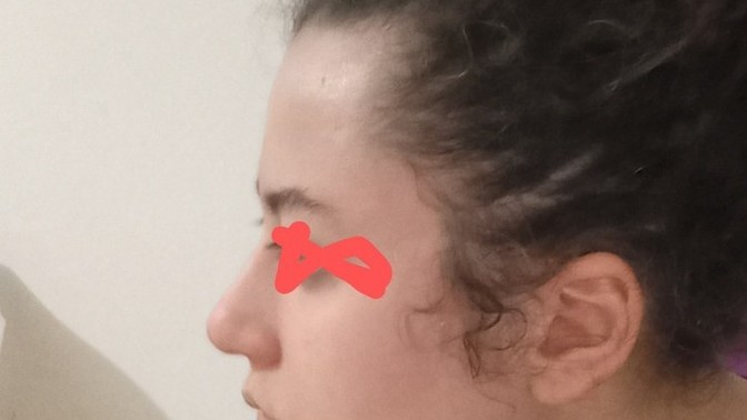 Yan profil sorunsalı! Burun estetiği gerekli mi?