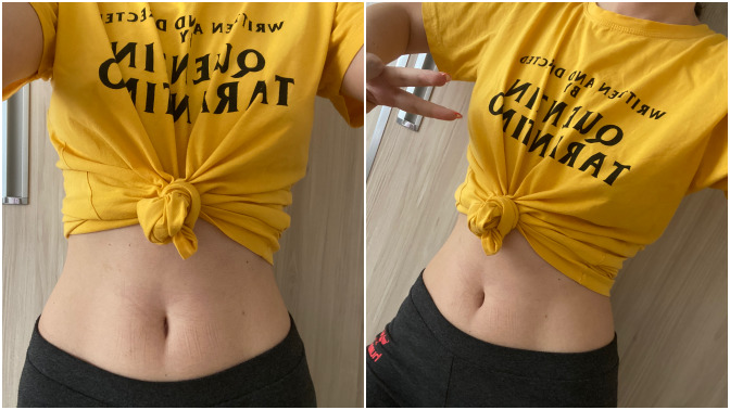 Tatilde bikini giyeceğim, sizce göbeğim yeterince ince mi?