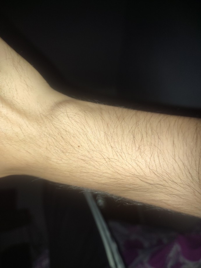 Elimdeki ganglion kisti mi yoksa normal mi?