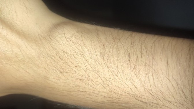 Elimdeki ganglion kisti mi yoksa normal mi?