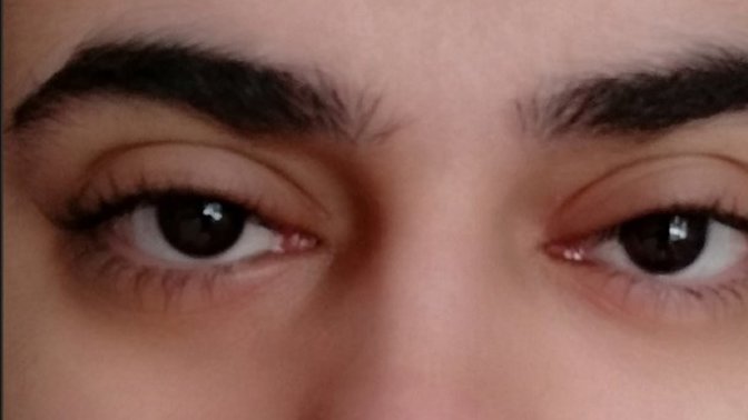 Göz kapağı şişliğine ne iyi gelir?