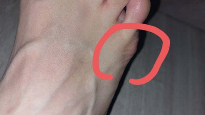 Ayağımın dış kemiği çok mu çıkık, paten giyince acıyor o kısmı?
