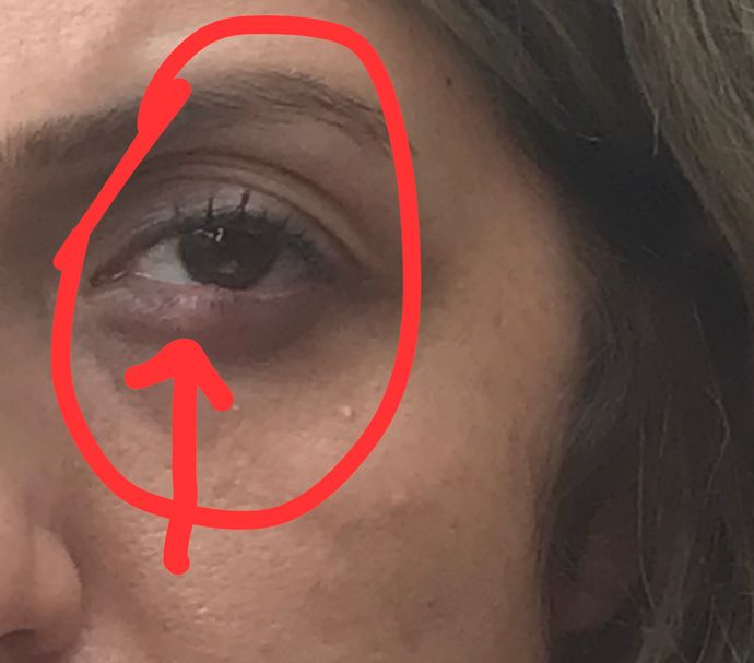 Eşimin gözünde böyle bir şey çıkmış, bir öneriniz var mı?