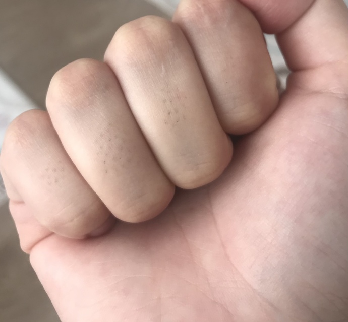 Parmak tüylerini ağda tam almıyor cımbızla alıyorum ama bu görüntü oluşuyor jiletle alsam bu noktaların önüne geçebilir miyim?