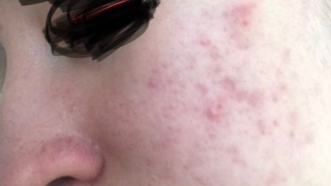 Nasıl bir cilt bakım rutini oluşturabilirim. Cilt bakımı ve ürünleri hakkında bilgim yok ciddiye ruaccutane verdi ama kullanmıcam?