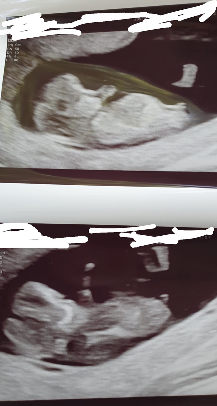 Selam anneler, ve babalar, aramizda gizli doktorlar, Sizce erkek mi kizim?