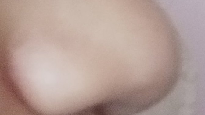Sizce estetik yaptırmalı mıyım burnuma (resimli)?
