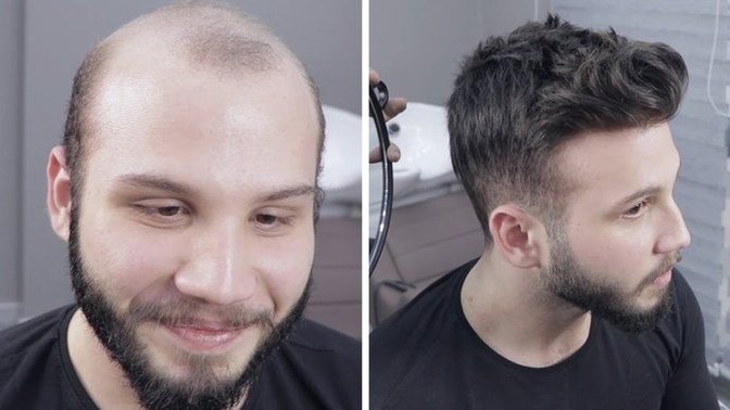 Nişanlımın saçları protez çıktı. Ayrılmalı mıyım?