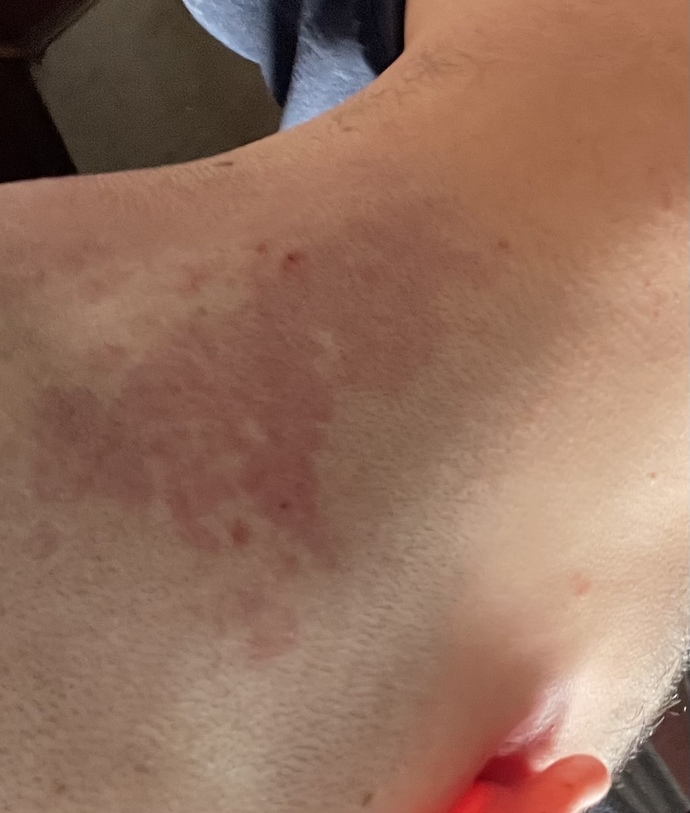 Arkadaşım saçlarını jiletle kazımış ama kırmızı lekeler var onlar nedir?
