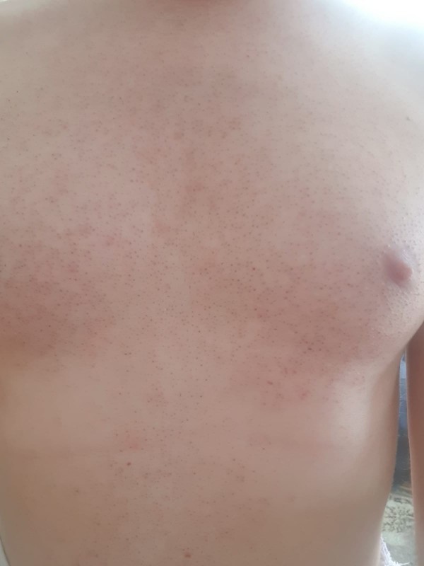 Lazer epilasyon sonrası izler geçer mi? Özel bölge için de yaptirmalimiyim sizce?