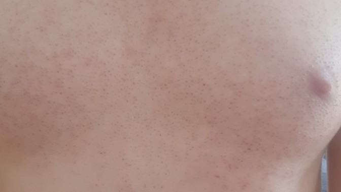 Lazer epilasyon sonrası izler geçer mi? Özel bölge için de yaptirmalimiyim sizce?