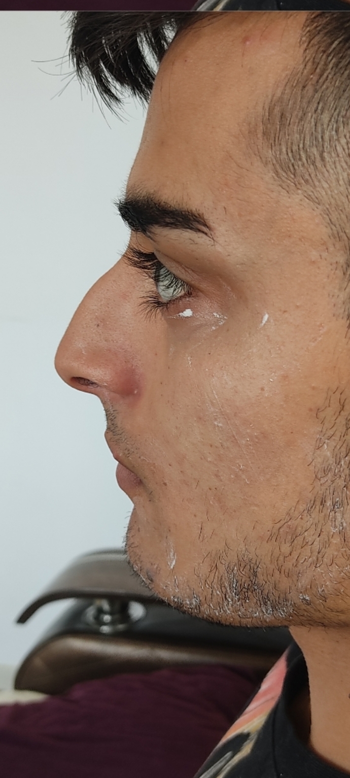 Burun estetiği olduktan sonra 6 ile 12 ay içinde değişiklik olur mu?