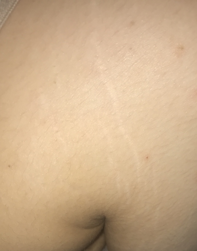Kilolu olduğumdan dolayı yan simitlerim ve kolum böyle çatlak nasıl geçer?