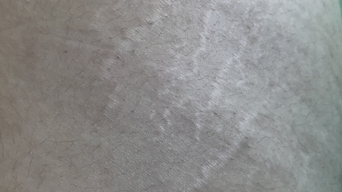 Kilolu olduğumdan dolayı yan simitlerim ve kolum böyle çatlak nasıl geçer?