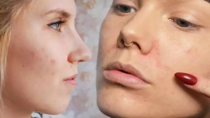 Sivilce izlerine ne yapılır?