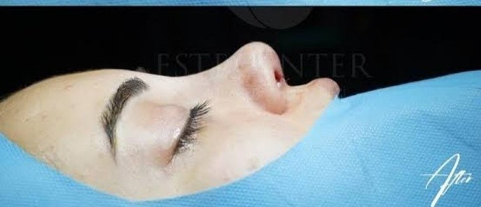 Burnumu asagidaki gibi yaptirmak istiyorum Konyada önerebileceginiz en iyi doktor hangisi🥳🤠?