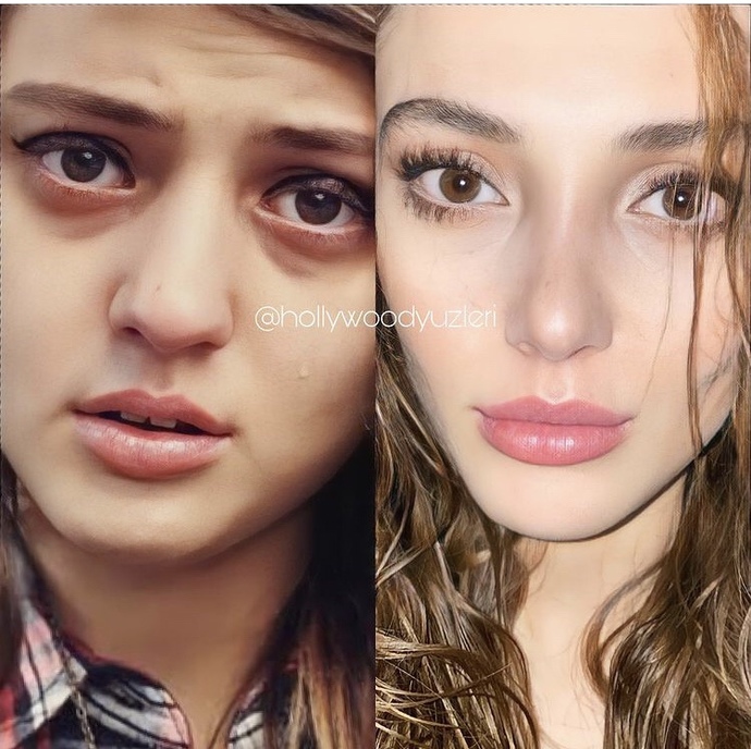 Yirmilik diş çekimi de estetiğe girer mi?