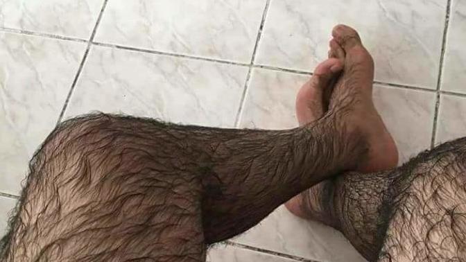 Bacaklarımı almalı mıyım yoksa kalsın mı çok rahatsız ediyor?