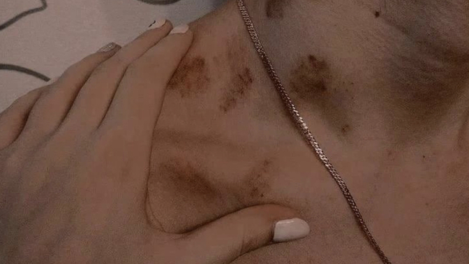Seks sonrası vücudunuzda kalan morluklar sizi rahatsız eder mi?