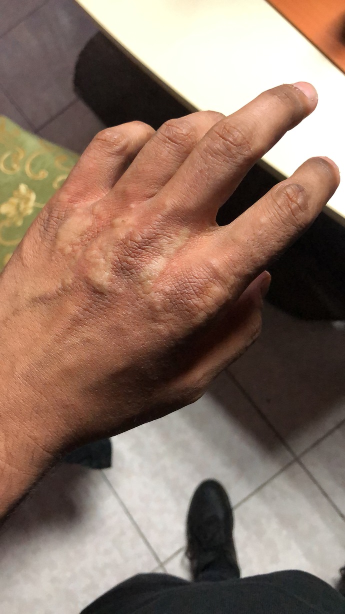 Ellerim birkaç gündür çok kaşınıyor ve bugün de kabarcıklar arttı. Sizce ciddi bir şey mi?