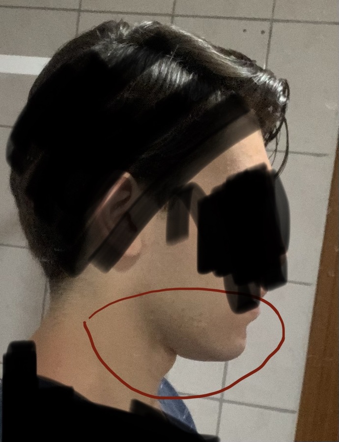 Çenemin altı yandan böyle nasıl düzelir?