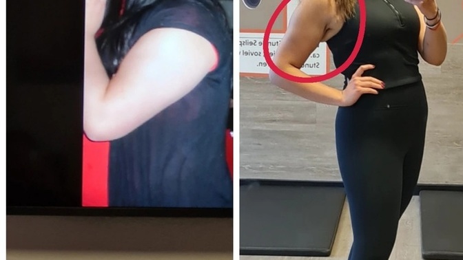 Üst koldaki bu kısım sporla gider mi yoksa bölgesel zayıflamaya devam mi etmeliyim veya gerdirmem mi gerekir?