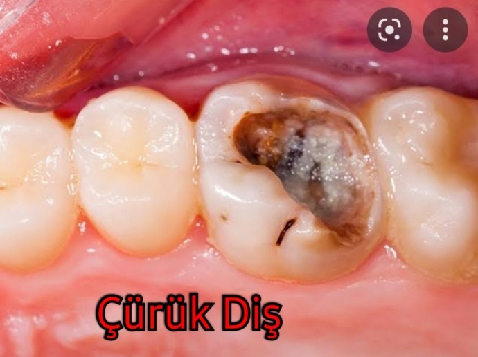 Selamlar 👋🏻😃 Diş Çürüğü Ve Ağrısını Yaşadınız mı? En Son Kaç Dişiniz Çürüdü Ne Yaptınız O Dişi 🦷?