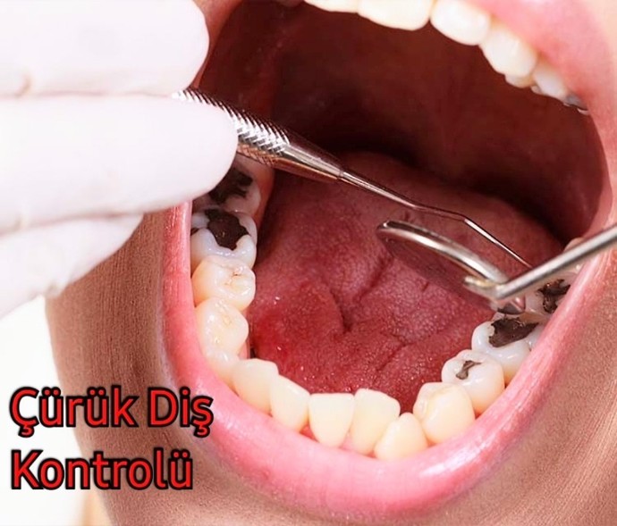 Selamlar 👋🏻😃 Diş Çürüğü Ve Ağrısını Yaşadınız mı? En Son Kaç Dişiniz Çürüdü Ne Yaptınız O Dişi 🦷?