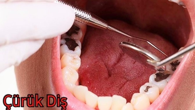 Selamlar 👋🏻😃 Diş Çürüğü Ve Ağrısını Yaşadınız mı? En Son Kaç Dişiniz Çürüdü Ne Yaptınız O Dişi 🦷?
