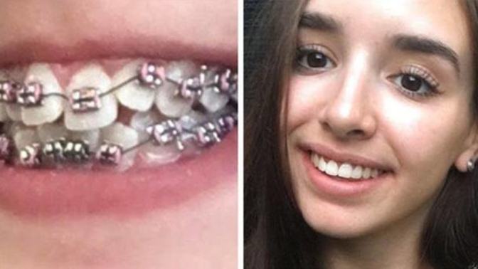 Diş teli kullanan var mı?