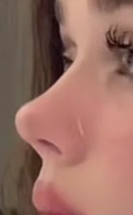 Burnumun ilk baştaki kız gibi olmasını çok isterdim sizce estetik yaptırmalı mıyım?