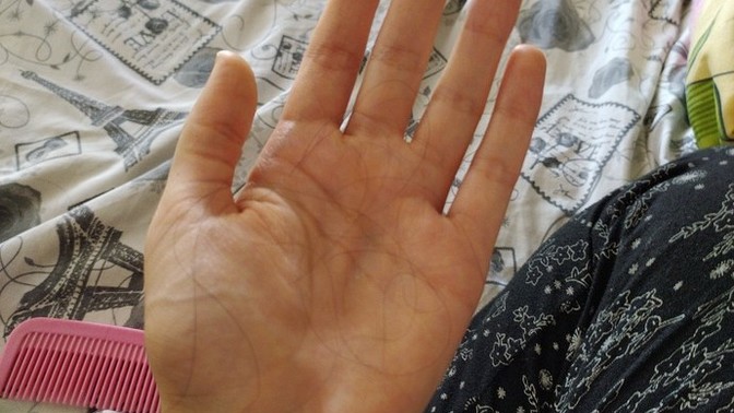 Saçlarım çok dökülüyor, ne yapacağım?