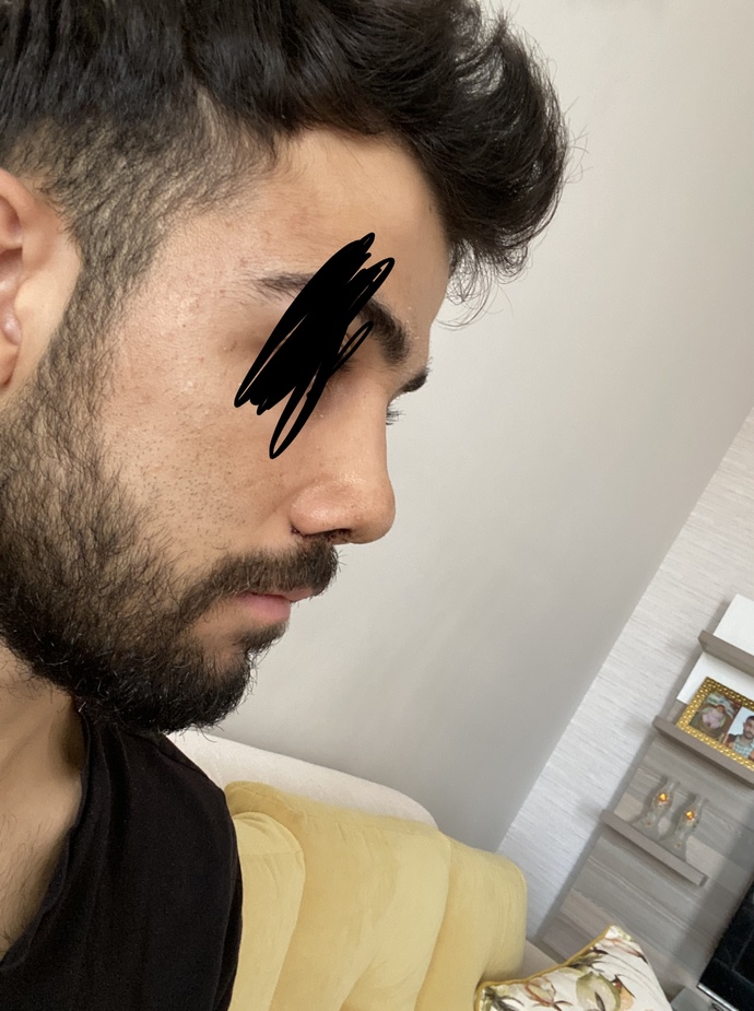 Burun estetiği sonrası ödemlerimi atmanın yolu var mı?