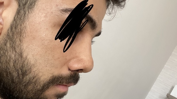 Burun estetiği sonrası ödemlerimi atmanın yolu var mı?