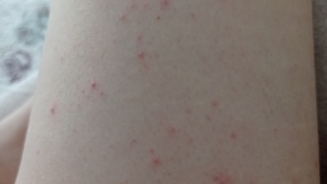 Bu alerjimi yoksa normal sivilcemi fotoğraf detayda?