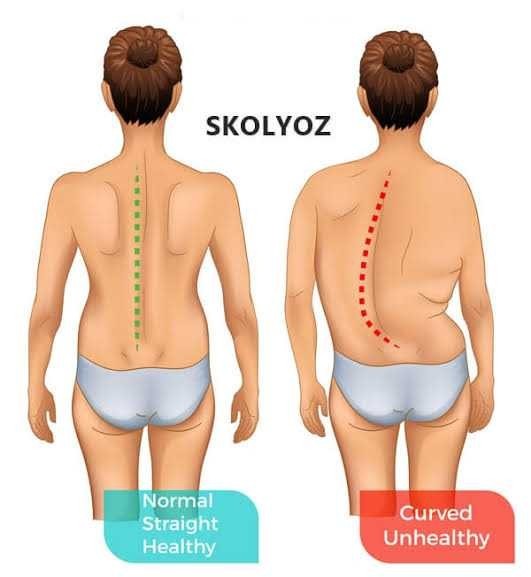 Skolyoz (omurga eğriliği) neden oluşur?