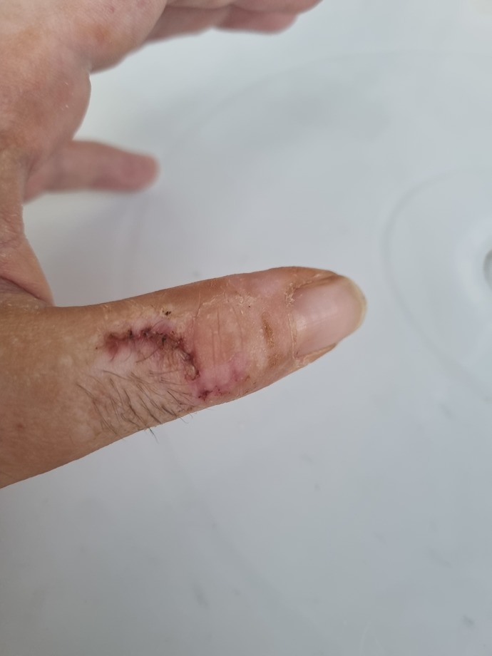 Arkadaşlar parmağım bu haldeyken bükememem normal mi?