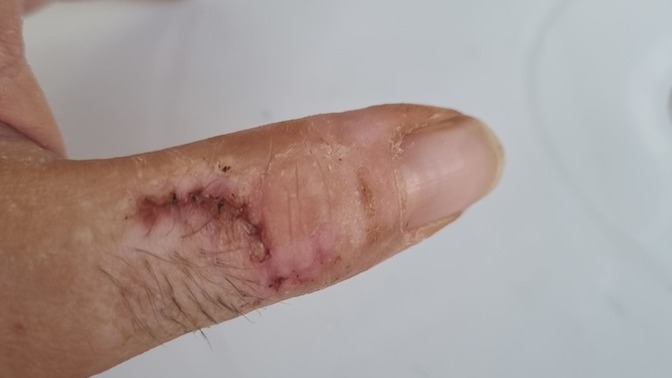 Arkadaşlar parmağım bu haldeyken bükememem normal mi?
