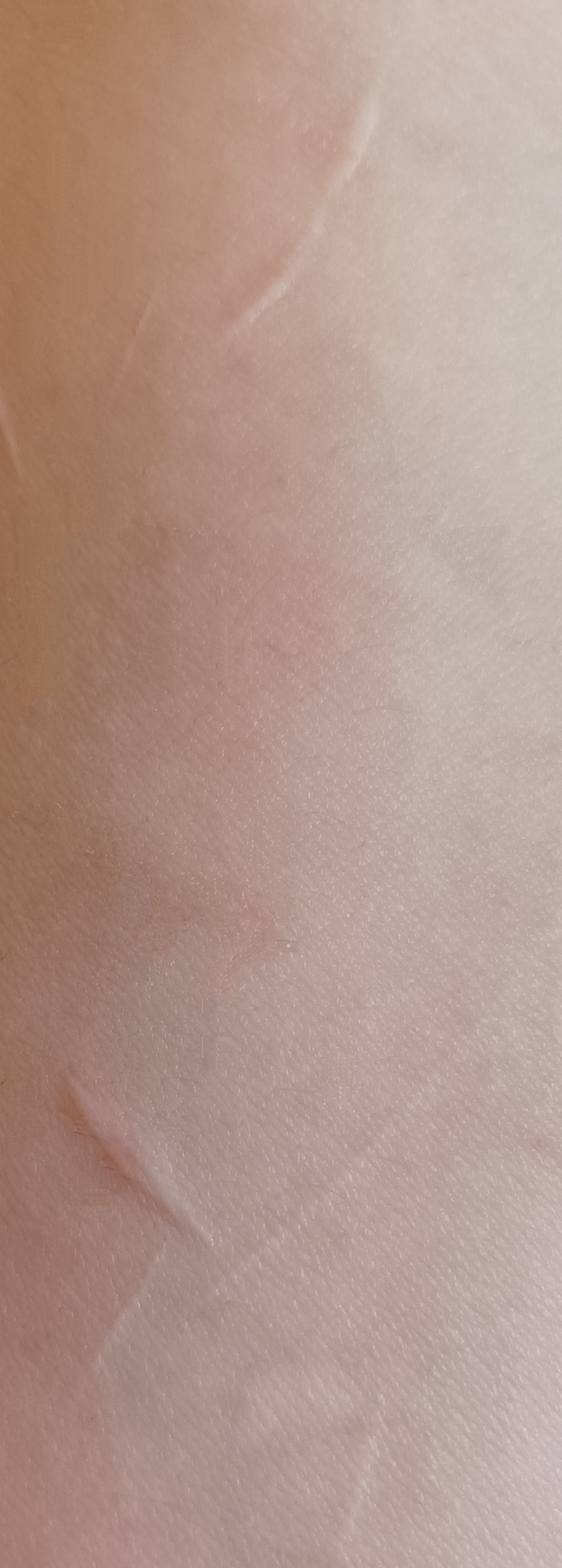 Elinde böyle yara izi olan yokmu?